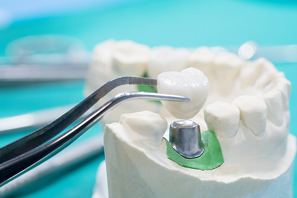 General Dentistry Solutions Using Dental Crowns